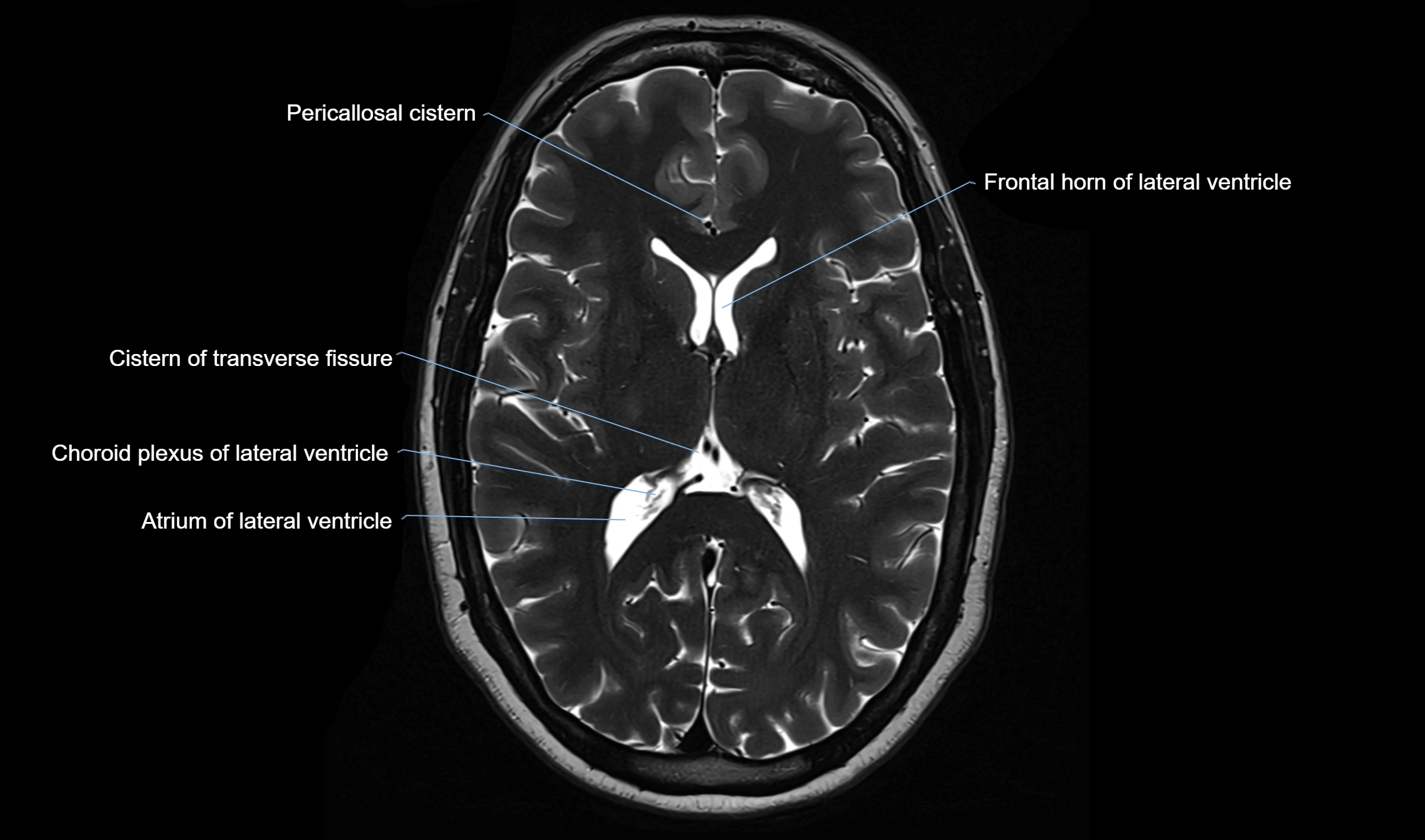 Brain cisterns  and ventricles  axial anatomy 3T MRI image-img-00001-00031.webp